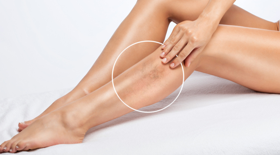 Besenreiser veröden (Sklerotherapie)